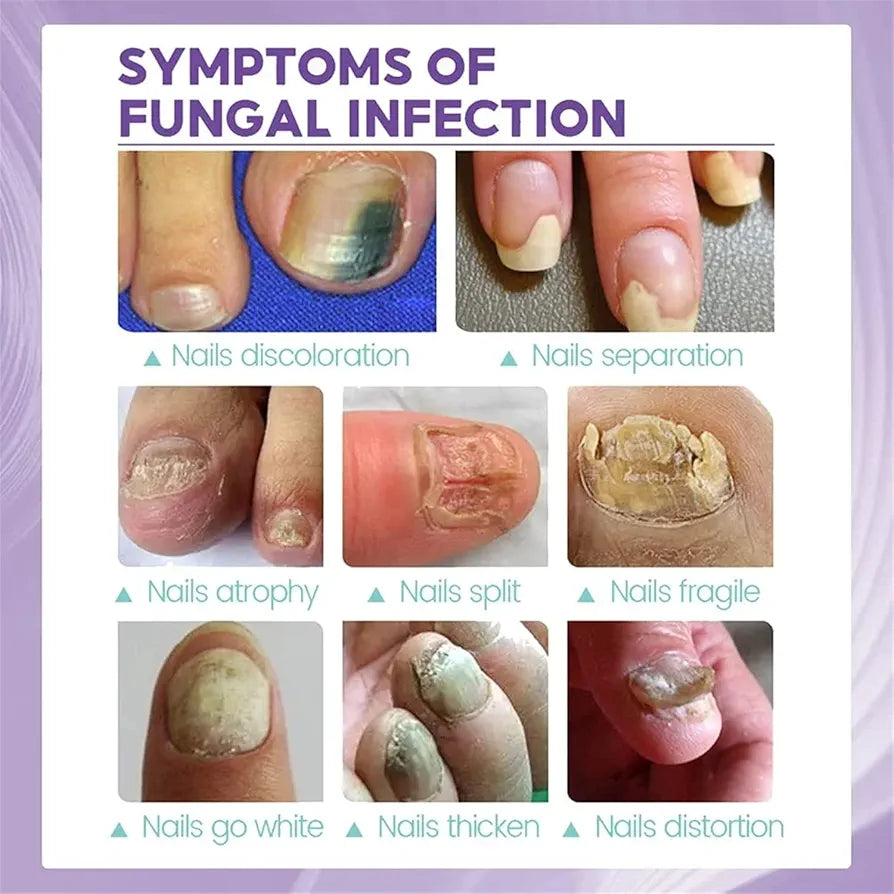 Nails fungus spray.
