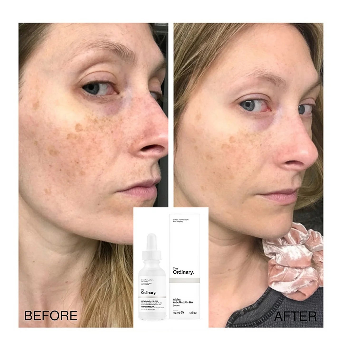 The Ordinary Alpha Arbutin Serum 2% + HA For Dark Spots & Hyperpigmentation (30ml).