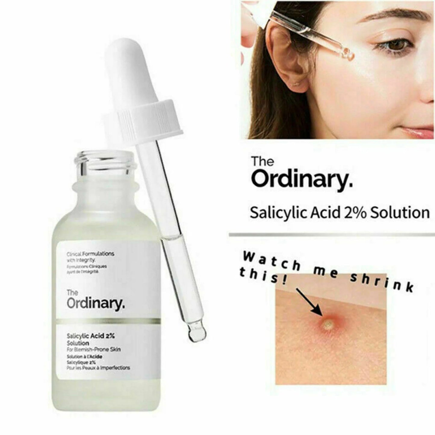 The Ordinary Salicylic Acid 2% Solution 30ml - Acne Prone Skin