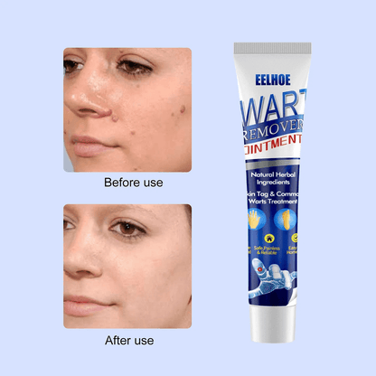 EELHOE Wart Remover Ointment - 20g